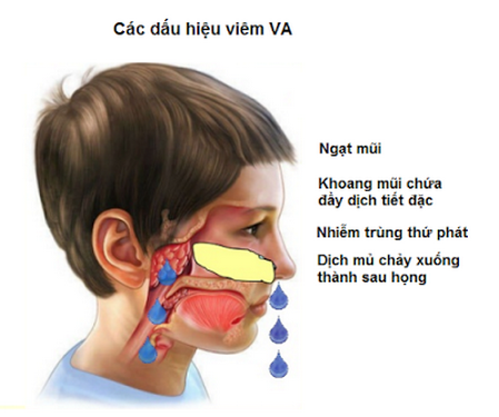 Triệu chứng viêm VA ở trẻ