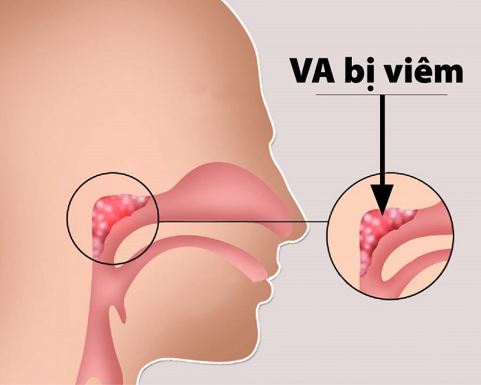Viêm VA xuất phát từ việc bạch cầu không có khả năng bắt hết virus, vi khuẩn