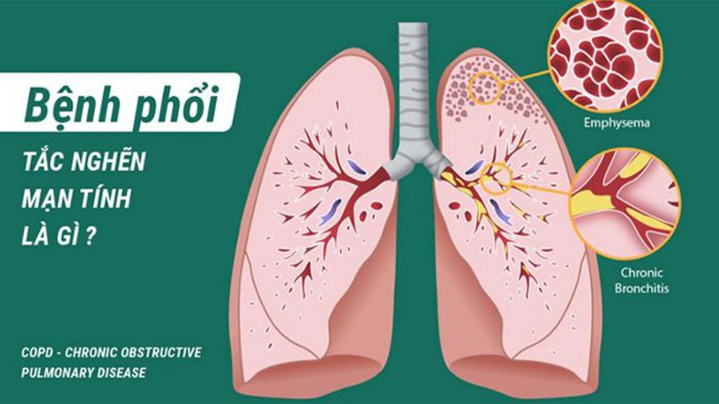 Tắc nghẽn phổi mãn tính là gì?